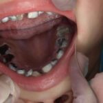 Cómo se puede prevenir la aparición de caries en los niños