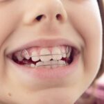 Cuáles son los beneficios a largo plazo de corregir la maloclusión dental en niños