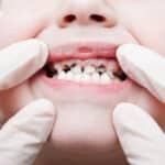 Cuáles son los beneficios de tratar las caries en los niños a temprana edad