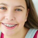 Cuáles son los cuidados especiales que deben tener los niños con brackets