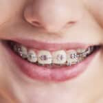 Cuáles son los diferentes tipos de brackets o aparatos de ortodoncia que existen para niños