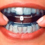 Existen tratamientos dentales específicos para niños con apnea del sueño